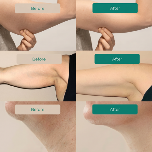LYMPHATIC DRAINAGE